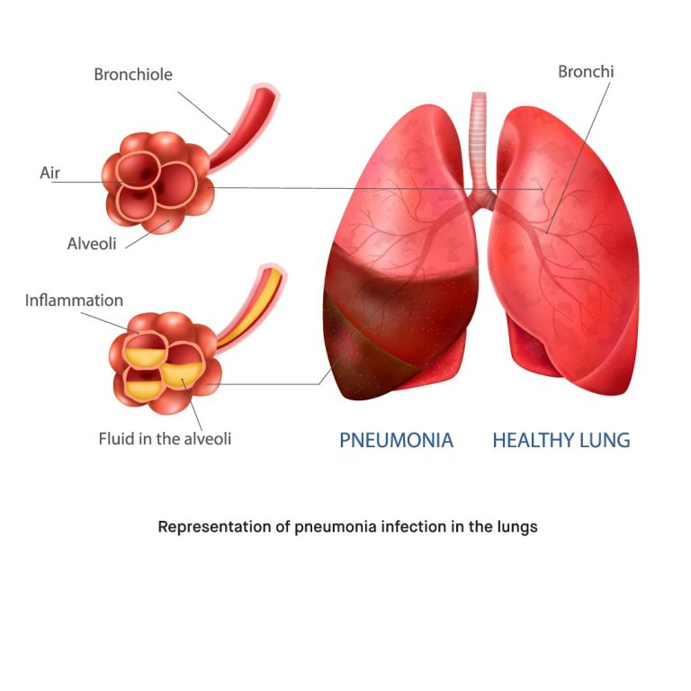 Mycoplasma pneumoniae